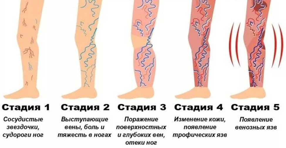 КЛАССИФИКАЦИЯ ВИДОВ ВАРИКОЗА ВЕН НИЖНИХ КОНЕЧНОСТЕЙ.png