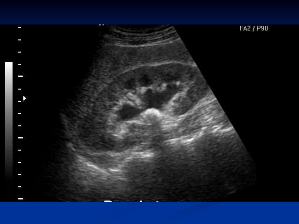 Как проводится УЗИ почек Как проводится УЗИ почек