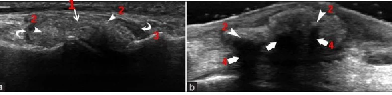 Для раннего подтверждения диагноза подагры используют УЗИ суставов.png Для раннего подтверждения диагноза подагры используют УЗИ суставов.png