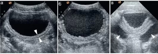 Частые вопросы об УЗИ мочевого пузыря Частые вопросы об УЗИ мочевого пузыря